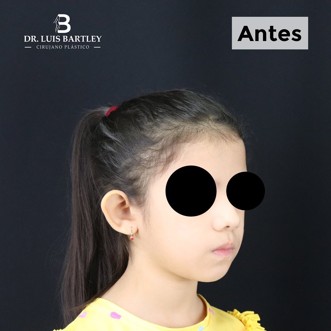 otoplastia en panamá niños (1)