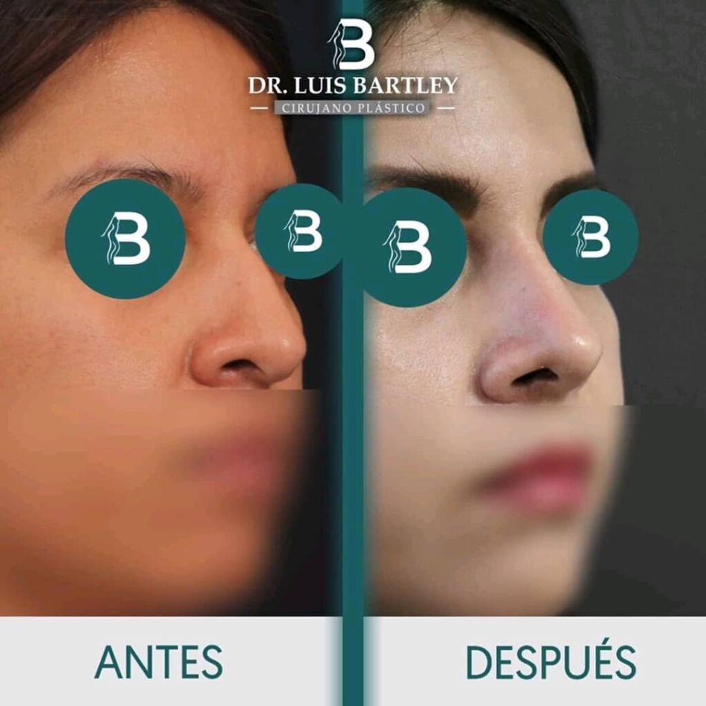rinoplastia en panamá 1 rinoplastia en panamá , antes y después