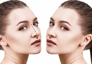 Rinoplastia en panamá Dr Bartley rinoplastia en Panamá dr bartley